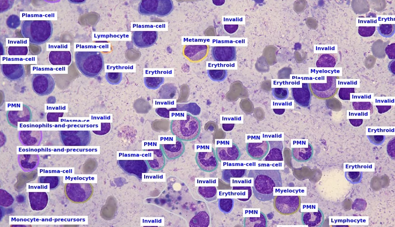 Differenzierung und Kategorisierung von kernhaltigen Knochenmarkzellen mit Microscope x Hema von aetherAI, das Bilder von DFK 33UX183 Mikroskopkameras analysiert. Bild: aetherAI